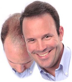 Hairloss treatment Hairloss treatment